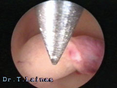 The endometrial polyp will be removed with hysteroscopic scissors. 